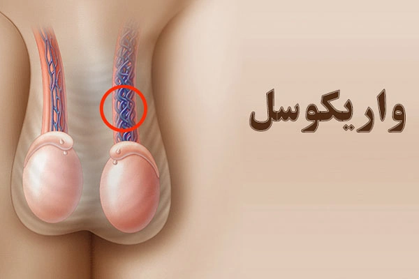 واریکوسل چیست