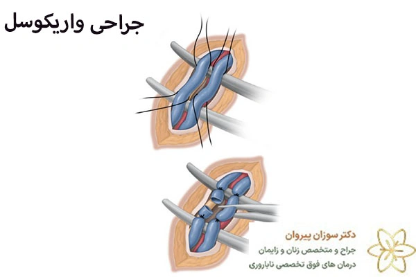 درمان واریکوسل با جراحی