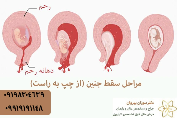 مراحل سقط جنین