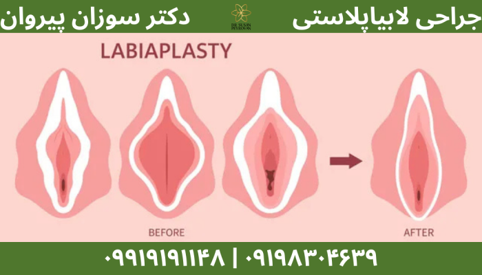 لابیاپلاستی