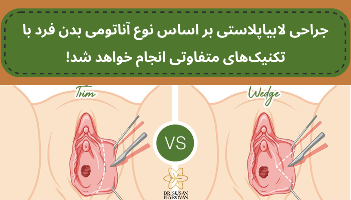 انواع تکنیک های لابیاپلاستی