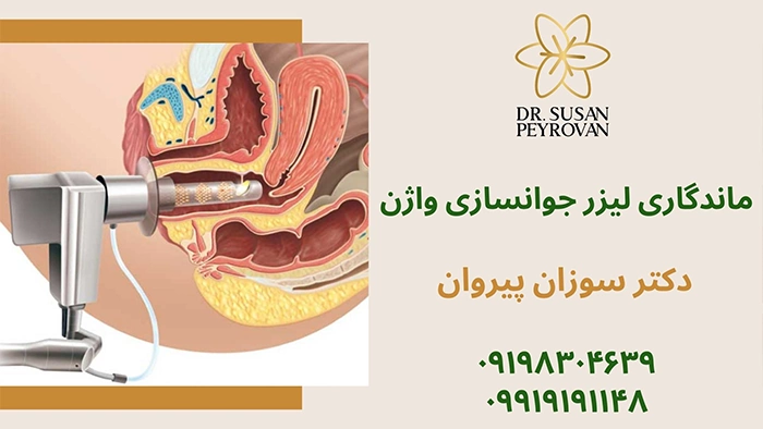 ماندگاری لیزر جوانسازی واژن