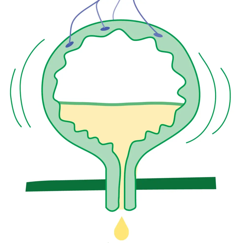 علل بی اختیاری ادرار در بارداری