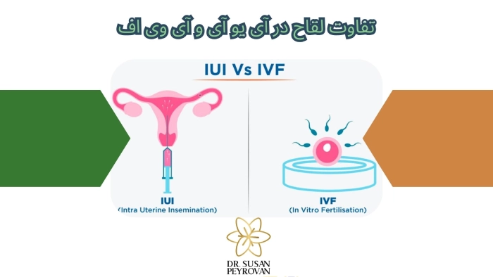 تفاوت لقاح در آی یو آی و آی وی اف
