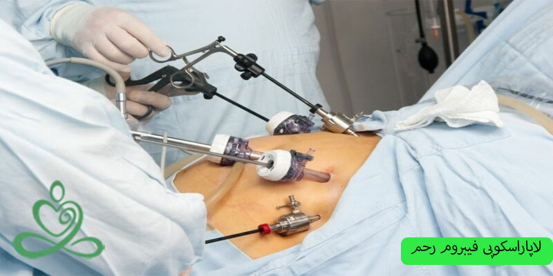 لاپاراسکوپی-فیبروم-رحم