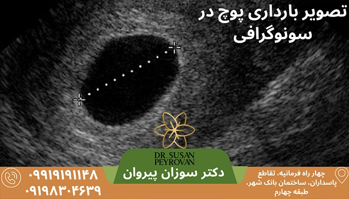 بارداری پوچ در سونوگرافی