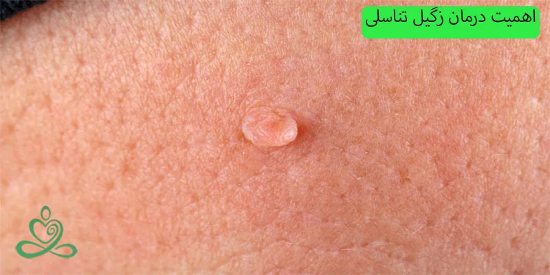 اهمیت-درمان-زگیل-تناسلی