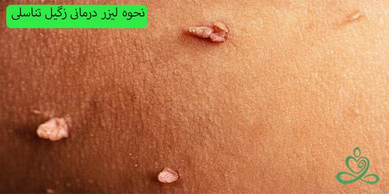 نحوه-لیزر-درمانی-زگیل-تناسلی