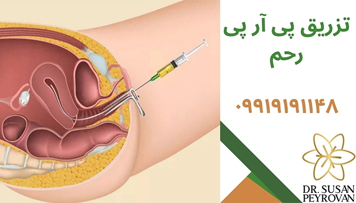تزریق پی آر پی رحم