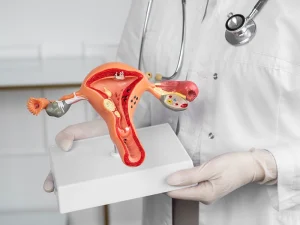 آر اف تخمدان