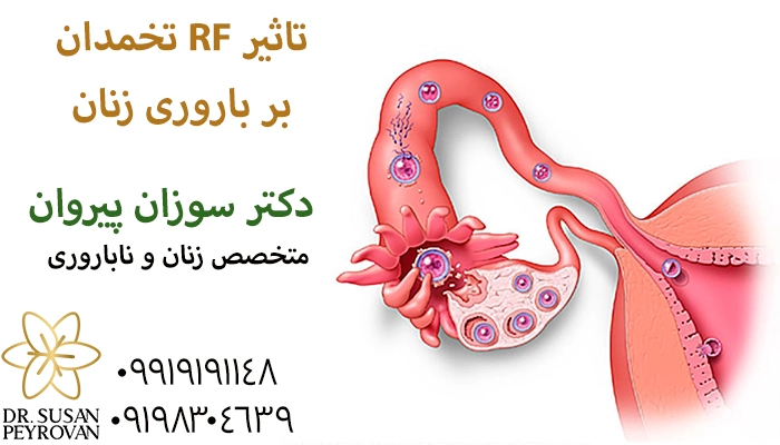 تاثیر آر اف تخمدان بر درمان ناباروری