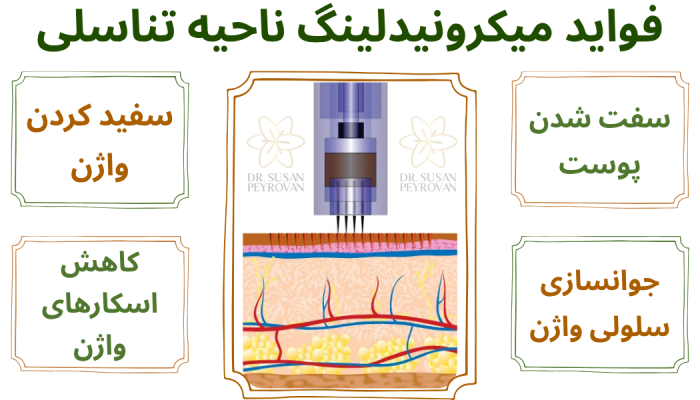 فواید میکرونیدلینگ ناحیه تناسلی