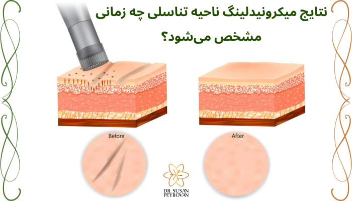 نتایج میکرونیدلینگ ناحیه تناسلی