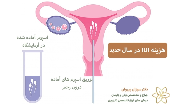 هزینه IUI در سال 1405